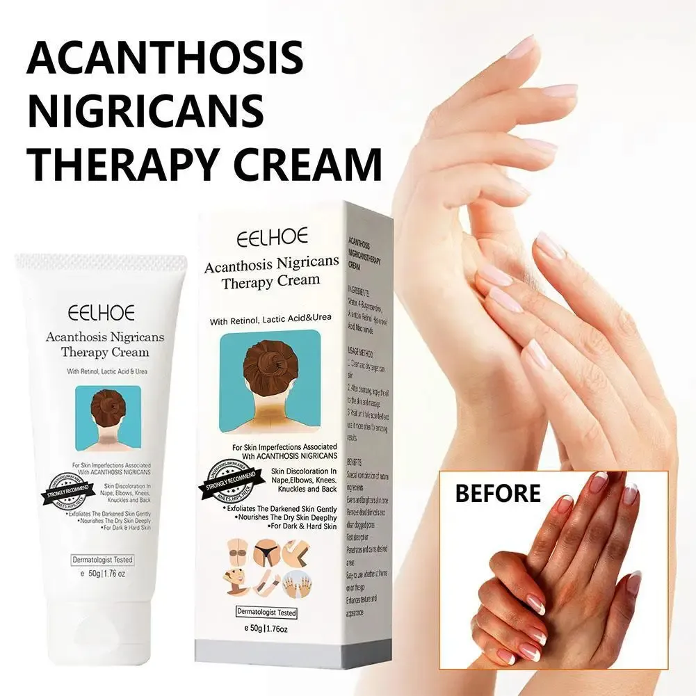 EELHOE Acanthosis Cream